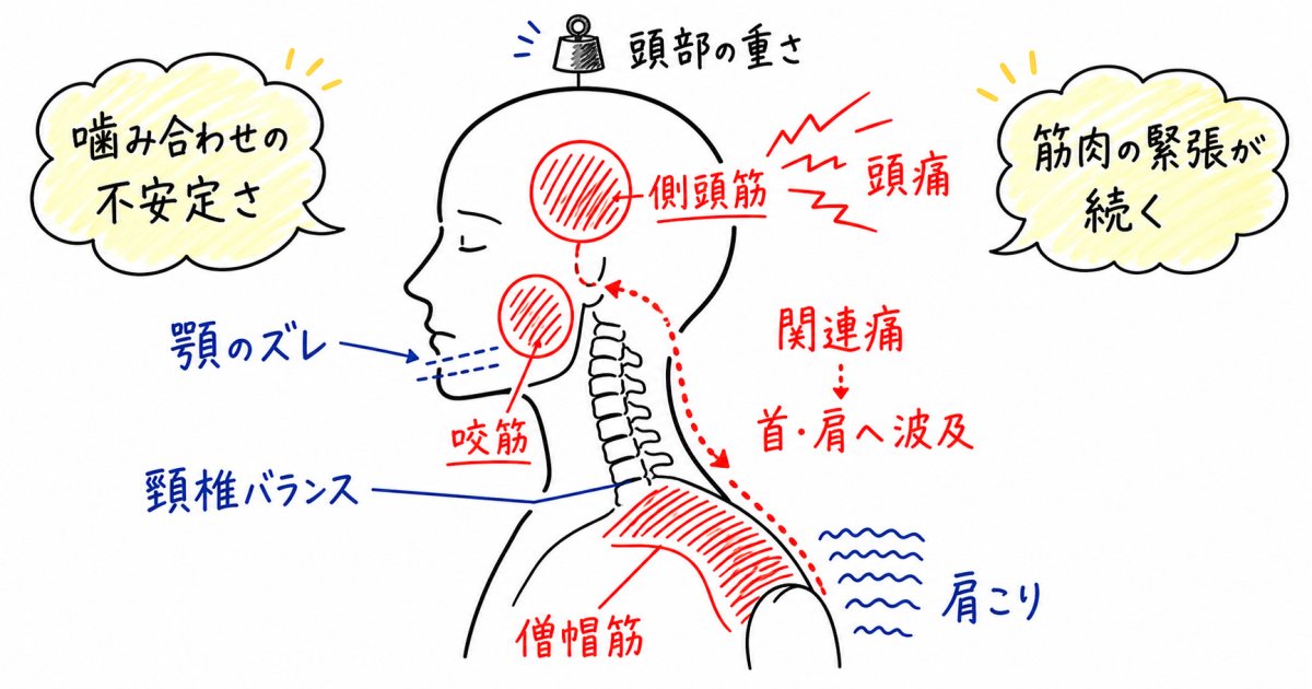 噛み合わせの悪化が頭痛や肩こりを引き起こす身体の仕組み
