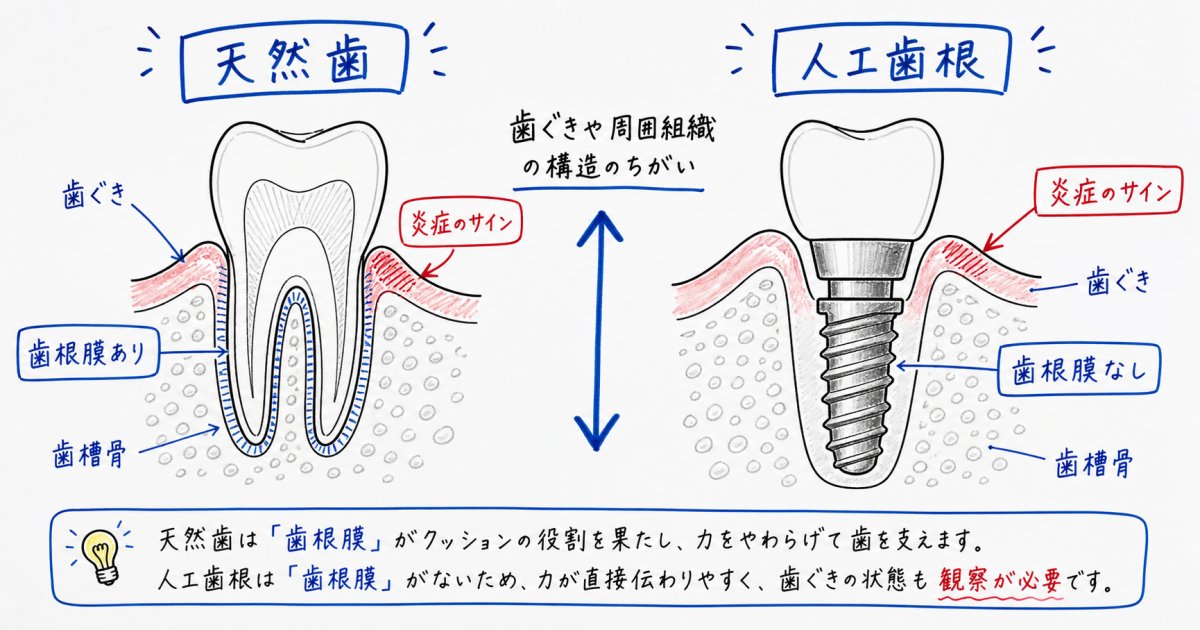 人工歯根周囲炎と歯周病の違いは？見逃せない症状と受診の目安