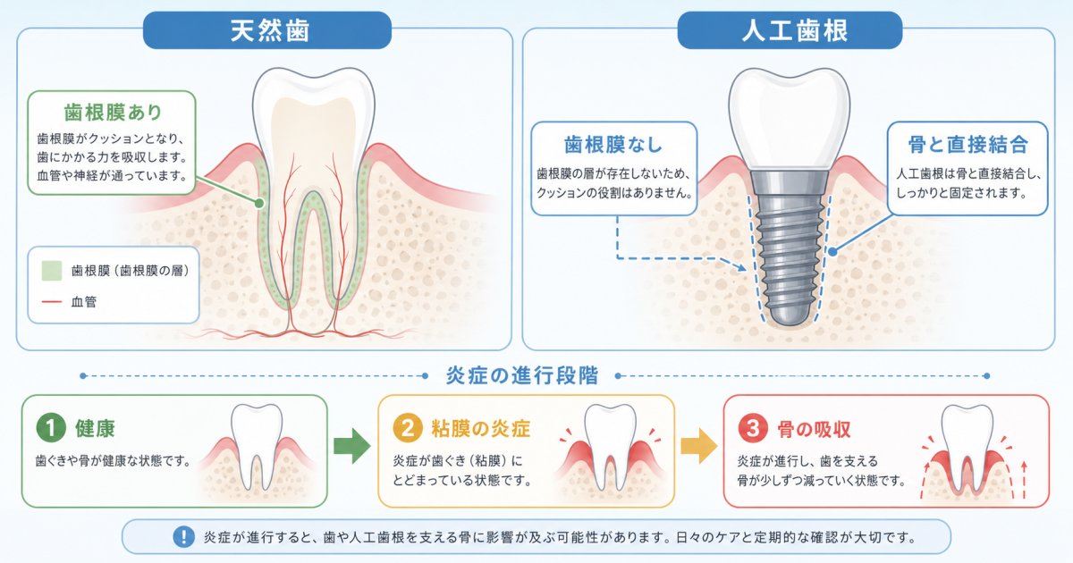 人工歯根周囲炎と歯周病の構造的な違いと進行スピード